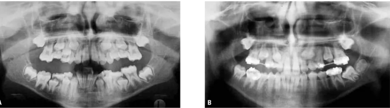 FIGURA 15 - A) Paciente com infraoclusão de molares decíduos diagnosticada no período intertransitório da dentadura mista