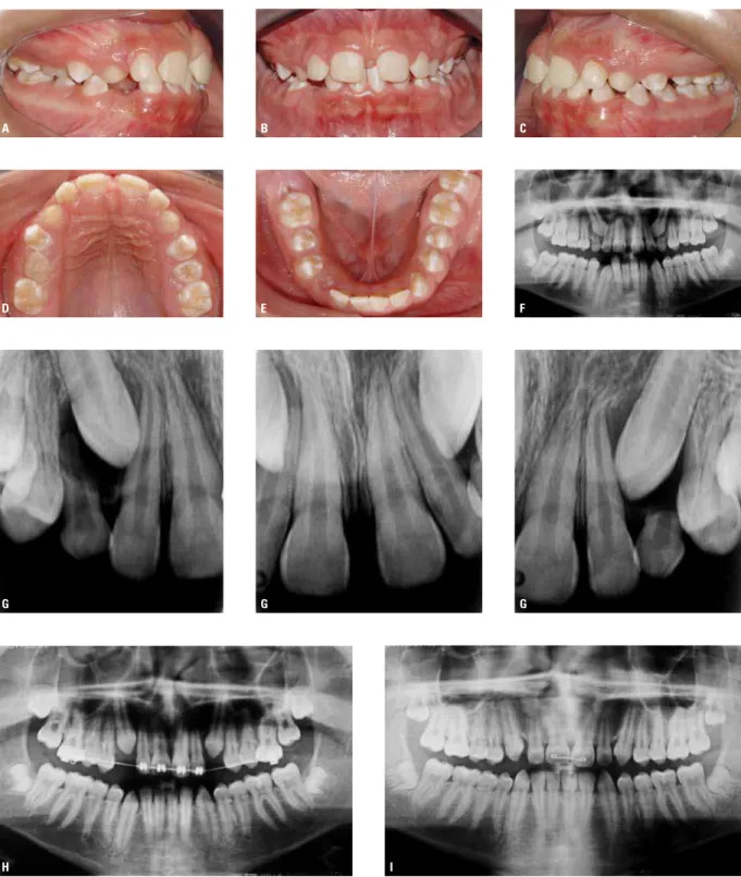 FIGURA 16 - Associação entre hipoplasia generalizada de esmalte (A a E) e erupção ectópica do dente 13 para palatino (F, G)