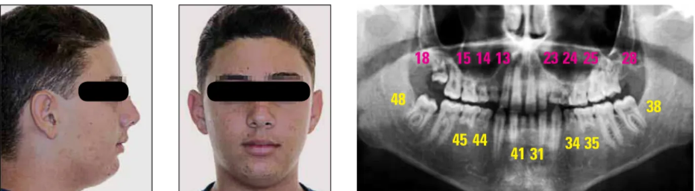 FIGURA 7 - Irmão mais jovem do paciente mostrado na figura 6. Aos 10 anos de idade apresenta agenesia de sete dentes permanentes, excetuando-se  os terceiros molares.