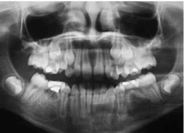 FIGURA 9 - Radiografia panorâmica de um paciente apresentando asso- asso-ciação entre múltiplas agenesias dentárias e a microdontia dos  incisi-vos laterais superiores.