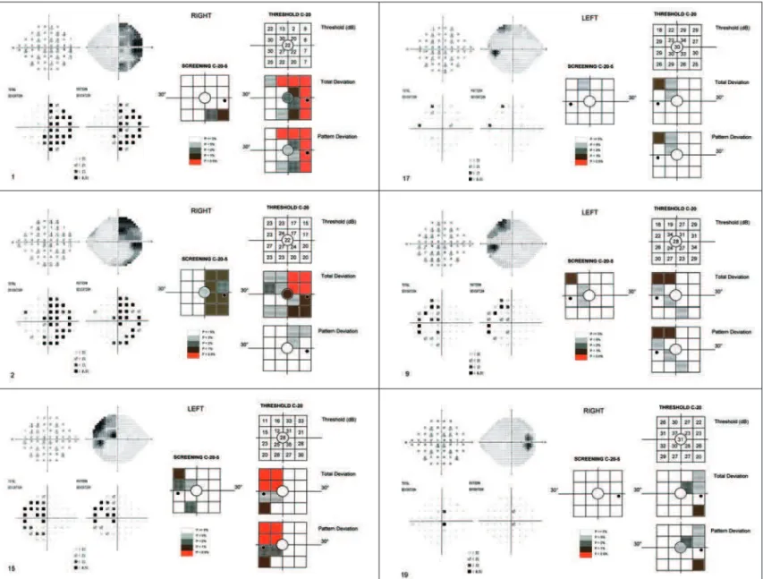 Figure 1 - Standard automated and frequency doubling technology perimetry in 6 of 12 eyes with temporal visual field defect on Goldmann perimetry.