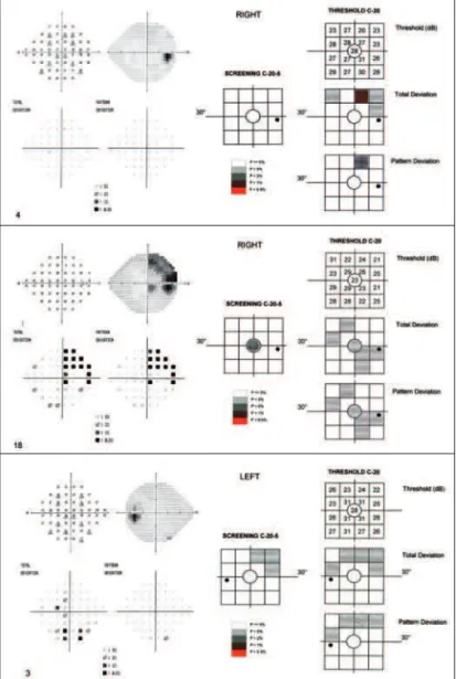 Figure 2 - Standard automated and frequency doubling technology (FDT) perimetry in eyes with temporal visual field defect on Goldmann perimetry
