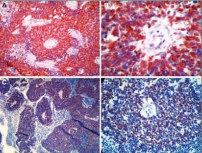 Figure - Microscope fields showing Ki-67 labeling in a overview of the tumor (100xs) and with amplified (250xs) respectively for patient 1: