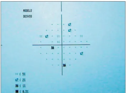 Figure 4 - IOL edge with OptiEdge design of Sensar ®  (AMO) showing the three different angulations and the vertical edge of the Acrysof ®  IOL