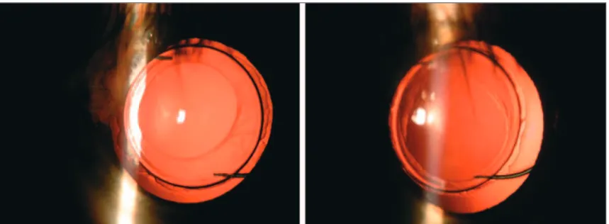 Figure 5 - Relationship between IOL and capsular bag revealing smaller overlapping of CCC at the left eye (right) when compared to the right eye (left)