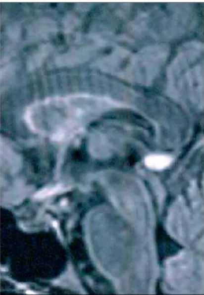 Figure 2 - MRI of the brain showing contrast enhancement of the chiasm