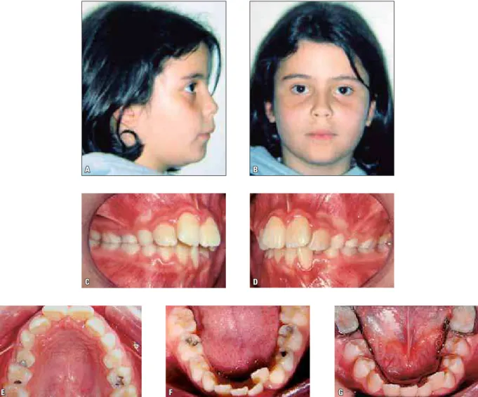 FIGURA 1 - Caso clínico 1. Fotografias iniciais faciais (A, B) e intrabucais (C a F). G) Arco lingual instalado para aproveitamento do leeway space.