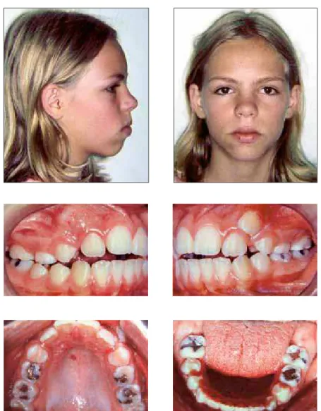 FIGURA 7 - Caso clínico 3: fotografias faciais e intrabucais iniciais.
