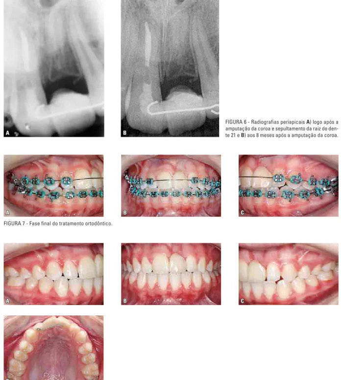 FIGURA 7 - Fase final do tratamento ortodôntico.