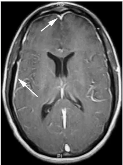 Figure 1 - Brain magnetic resonance imaging in a patient with neurosy- neurosy-philis and vitreitis: axial T-1 weighted image after gadolinium injection
