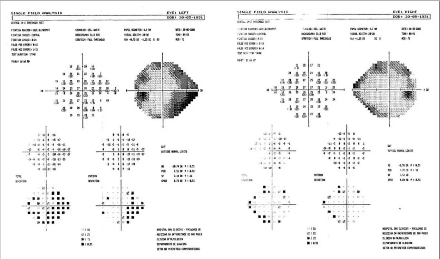 Figure 1 - Patient one visual field defect