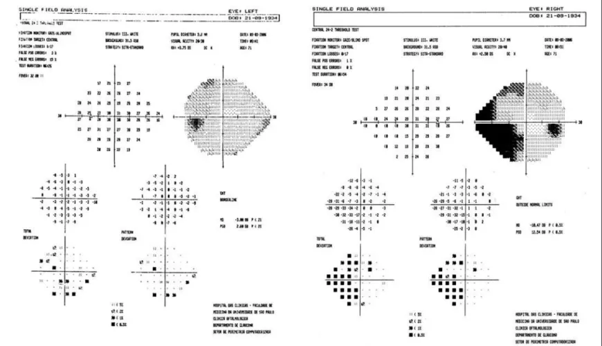 Figure 3 - Patient three visual field defectFigure 2 - Patient two visual field defect