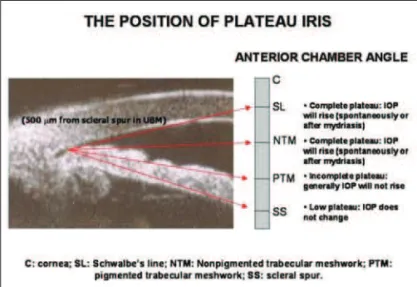 Figure 2 depicts the relation of the plateau iris position (the level of the iris relative to Schwalbe’s line and the structures of the angle wall) and the possibility of acute crisis of glaucoma liable to occur spontaneously or after mydriasis (24)  and F