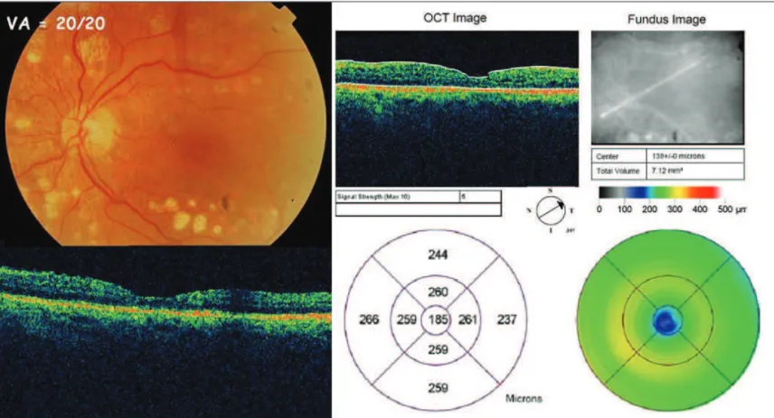 Figure 3 - Postoperative: patient showing visual acuity improvement 9 months after the surgical procedure