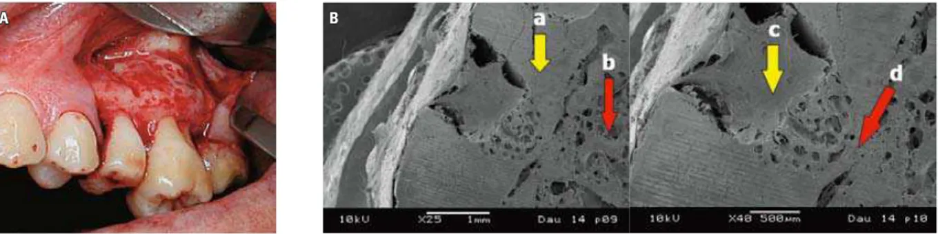 FIGURA 1 - A) Aspecto clínico da corticotomia alveolar. B) Imagem de microscopia eletrônica de varredura mostrando a profundidade atingida pela broca  no osso alveolar de cães, onde: (a) osso cortical; (b) osso trabecular; (c) injúria cirúrgica sendo preen