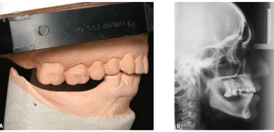 FIGURA 5 - Imagens pré-tratamento: A) fotografia dos modelos de gesso mostrando a extrusão severa dos dentes 15, 16 e 17; 