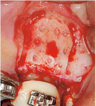 FIGURA 8 - Fotografias intrabucais ilustrando a evolução da intrusão do dente 16: A) pré-tratamento; B) uma semana pós-corticotomias e início da aplica- aplica-ção das forças intrusivas; C) quatro meses após as CAS, com nivelamento ideal praticamente alcan