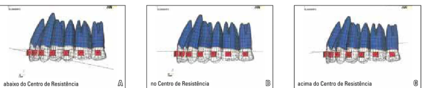 FIGURA 1 - Reprodução dos três modelos de aparelho extrabucal cervical com diferentes inclinações do arco externo em relação às coordenadas X, Y e Z,  utilizando o programa Ansys 8.1: A) AbCR (abaixo do Centro de Resistência); B) CR (no Centro de Resistênc