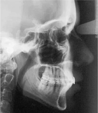 FIGURA 1 - Radiografia cefalométrica de perfil.