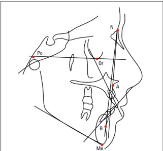 FIGURA 4 - Traçado cefalométrico com pontos e linhas demarcados.