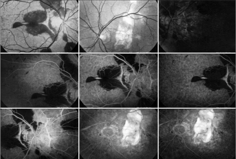 Figure 1 - A disciform scar in OS, and in OD subretinal neovascularization and choroidal rupture, accompanied by a wide submacular hemorrhage,  as seen on fluorescein angiography