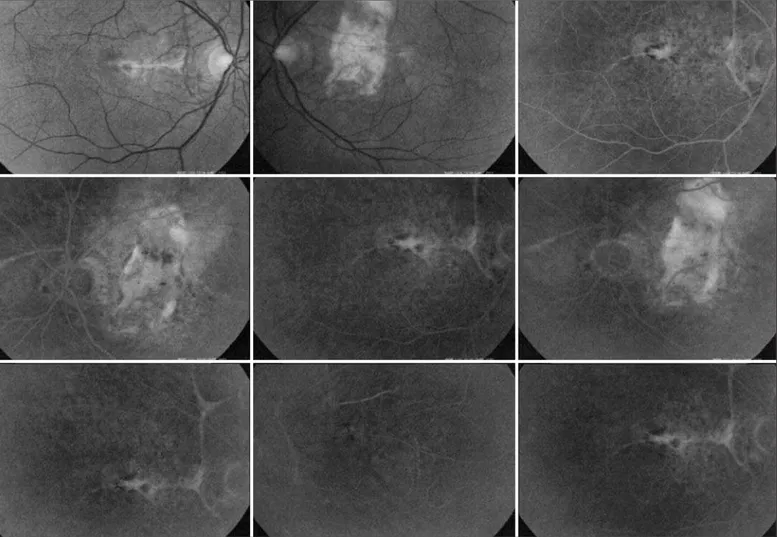 Figure 2 - There was no evidence of macular hemorrhage nor leaking of the neovascular complex in OD one month after bevacizumab