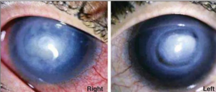 Figure 1 - Bilateral Acanthamoeba keratitis