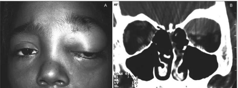 Figure 1 - A: Non-axial left eye proptosis and upper eyelid edema immediately after frontal trauma