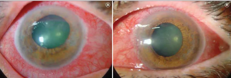 Figure 1 - Conjunctival hyperemia, corneal edema, iris atrophy, and fixed moderately dilated pupils are seen in the right (A) and left (B) eyes BA
