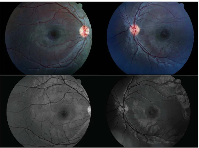 Figure 1 - Spoke wheel-like maculopathy