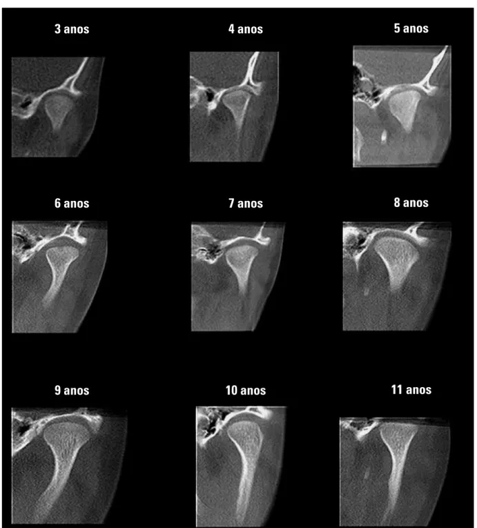 FIGURA 3 - Sequência da variação morfológica do côndilo mandibular em função da idade, no corte frontal.