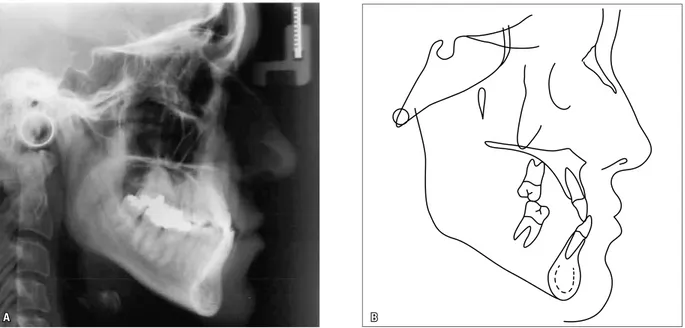 FIGURA 4 - Radiografia cefalométrica de perfil (A) e traçado cefalométrico (B) iniciais.
