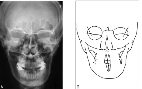 FIGURA 5 - Radiografia cefalométrica frontal (A) e traçado cefalométrico (B) iniciais.