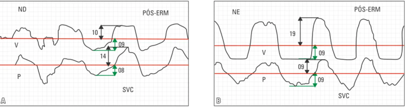 FIGURA 9 - Traçado do exame rinomanométrico após a expansão rápida da maxila (ERM): A) cavidade nasal direita e B) cavidade nasal esquerda.