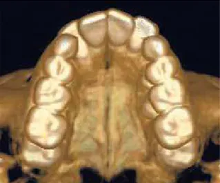 FIGURA 2 - Reconstrução tridimensional oclusal da maxila a partir da  tomografia computadorizada, demonstrando a sutura palatina  media-na aberta.