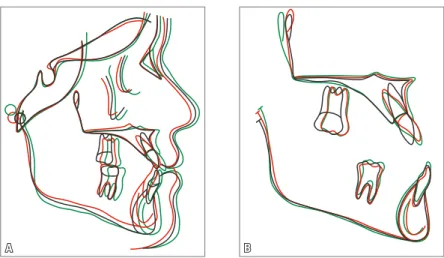 FIGURA 15 - Sobreposições A) total e B) parciais dos traçados cefalométricos inicial (preto), final  (vermelho) e de controle seis anos após o término do tratamento (verde).