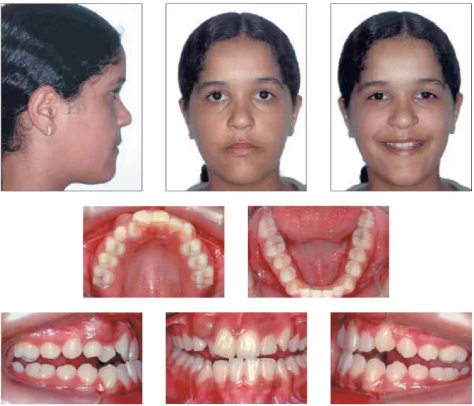 FIGURA 1 - Fotografias faciais e intrabucais iniciais, em RC.