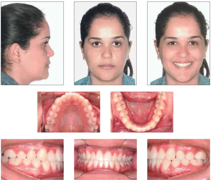 FIGURA 11 - Fotografias faciais e intrabucais de controle seis anos após o término do tratamento.