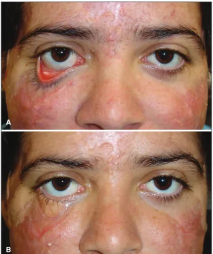 Figure 2 - Detail: A) Preoperative; B) 6-month post-operative