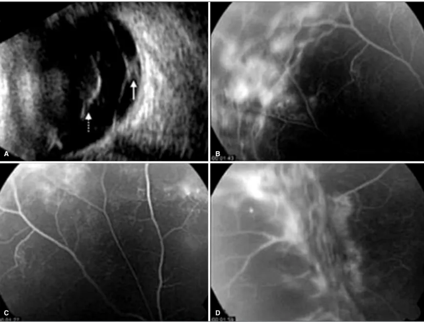 Figure 1 - A) B-mode ultrasonography with a 10 MHz probe in longitudinal section of 12 h of the left eye showing vitreous hemorrhage (dotted arrow) and traction retinal detachment in superior equatorial area  (continuous arrow)