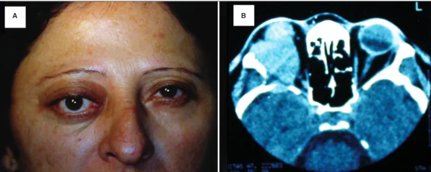 Figure 1 - A) Clinical photograph showing 42-year-old woman with proptosis in the right eye