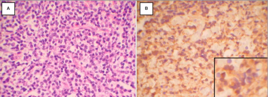 Figure 2 -  A) Plasma cells diffusely infiltrate the orbit (hematoxilin and eosin). B) Immunohistochemical stain positive for Kappa light chain