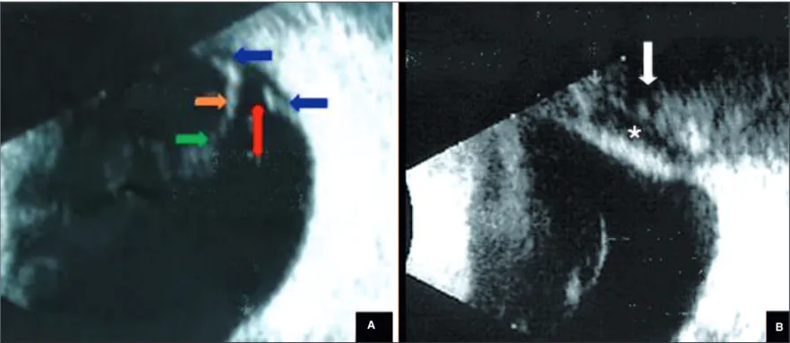 Figure 1 - B-Mode ultrasonography with a 10 MHz probe showing the preoperative (A) and postoperative (B) aspect of upper temporal periphery in lengthwise sections of the right eye