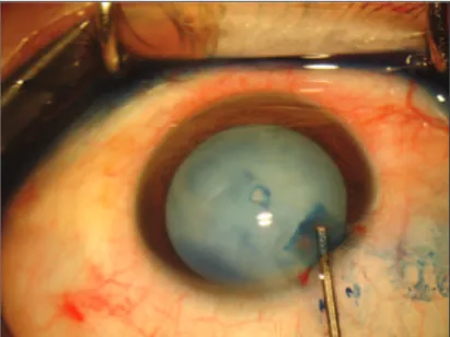 Figure 1 - Photograph of a single, central capsulotomy after Nd:YAG laser and use of trypan blue