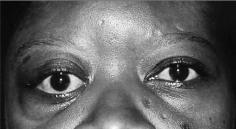 Figure 1 - External photograph of the patient showing right-sided proptosis and slight downward deviation of the right eye