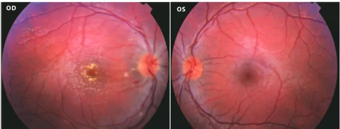 Figure 1.  Disc edema and macular star in the OD and normal OS.