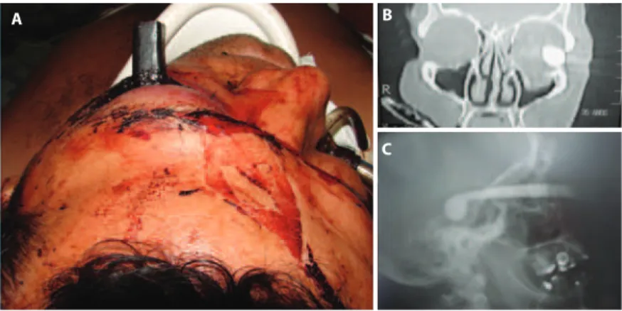 Figure 4. A) Foreign body in left orbit; B) Computed tomography (coronal view) showing object in right orbit; C) Lateral x-ray of skull showing object in sella turcica region.