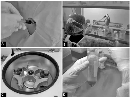 Figure 1.  Sequence of photos showing the collection of bone marrow (A) and initial separation of the mononuclear cells using Ficoll’Hypaque gradient centrifugation (B)(C)(D).