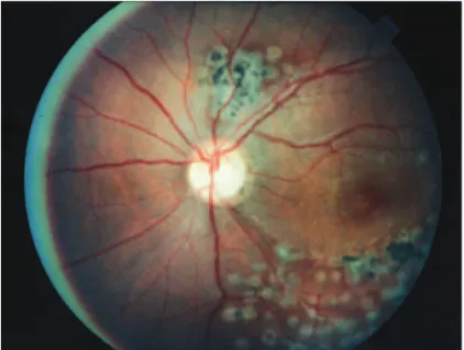 Figure 6. Multiples laser scars 16 years later in the right eye.