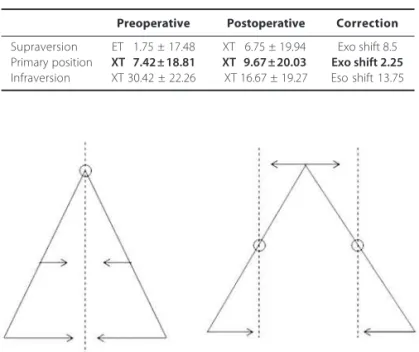 Figure 1. Shematic representation of the effect of the surgical weakening of the superior oblique muscles on the correction of the “A” anisotropia.